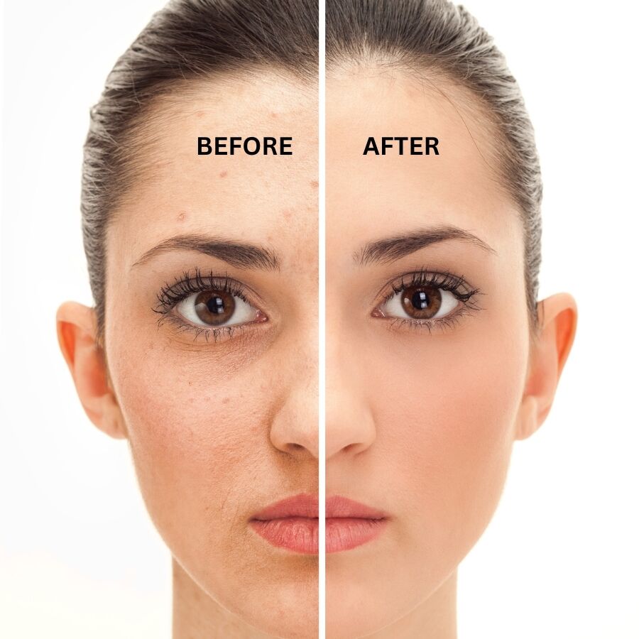 Before and after usage of hyaluronic acid serum